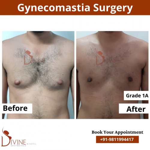 gynecomastia before after pics