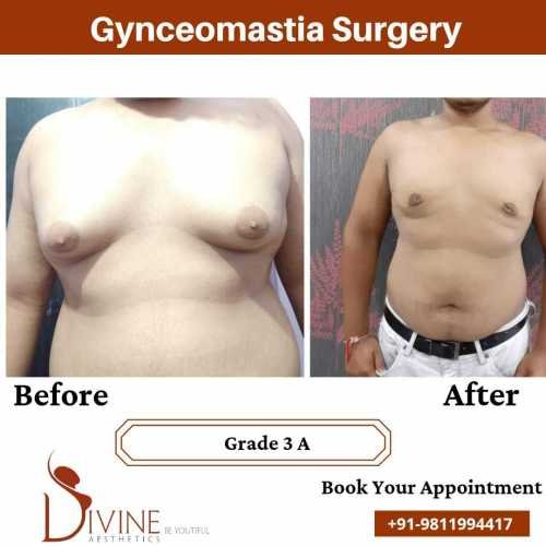 best-gynaecomastia-surgeon-in-delhi