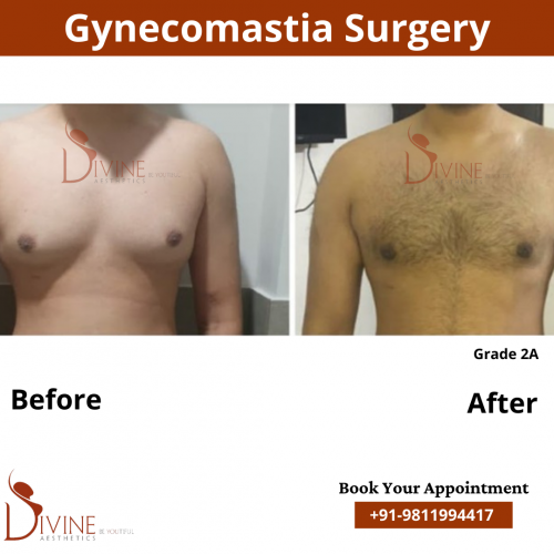gynecomastia before after pics
