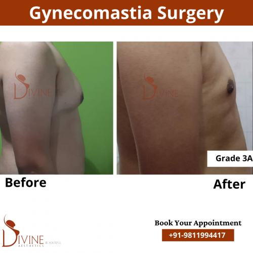 gynecomastia before after pics