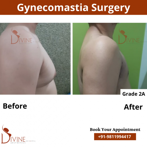 gynecomastia before after pics