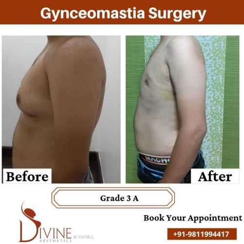 best-gynecomastia-surgeon-in-delhi