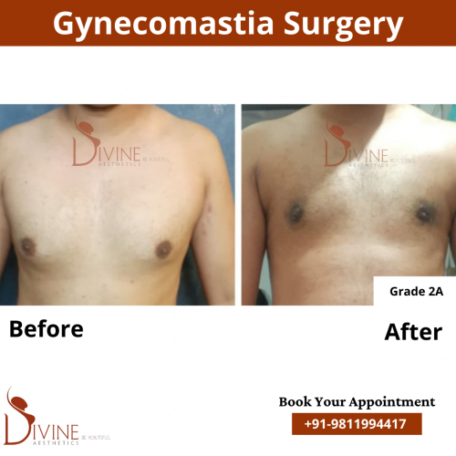 gynecomastia before after pics