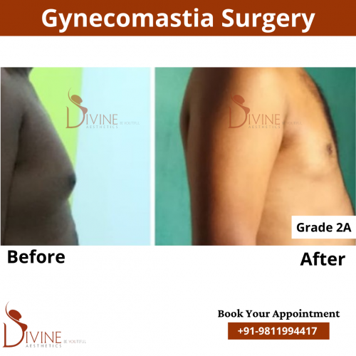 gynecomastia before after pics