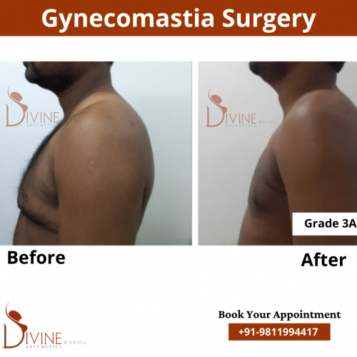 gynecomastia before after pics