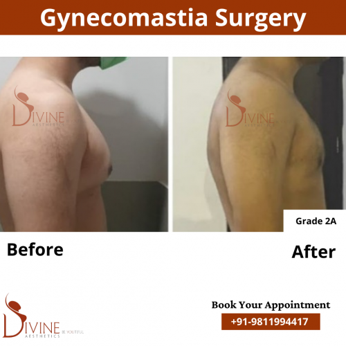 gynecomastia before after pics