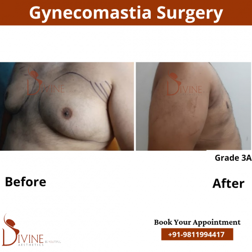 best-gynecomastia-surgery-in-delhi-1