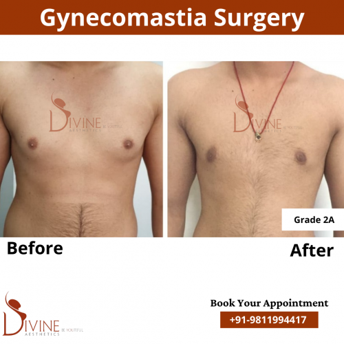 gynecomastia before after pics