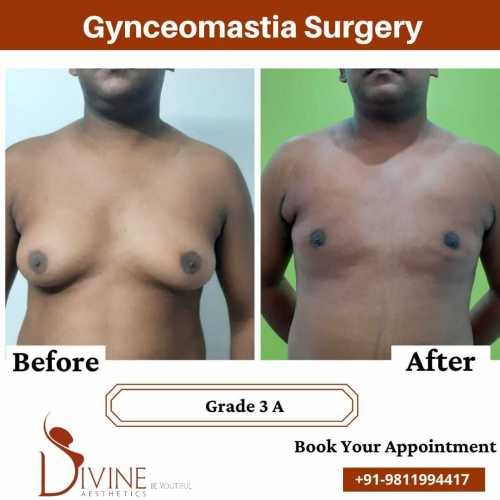 gynaecomastia-surgery-in-delhi