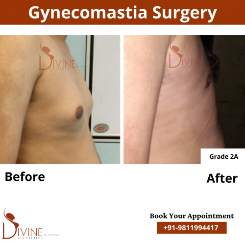 gynecomastia before after pics