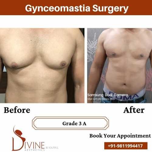 gynecomastia-cost-in-delhi