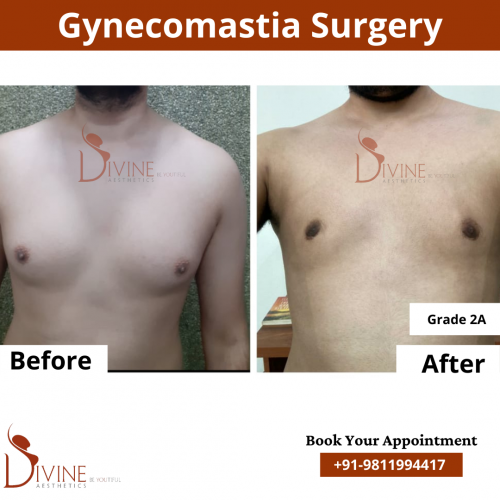 gynecomastia before after pics