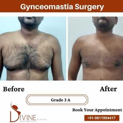 gynecomastia-doctor-in-delhi