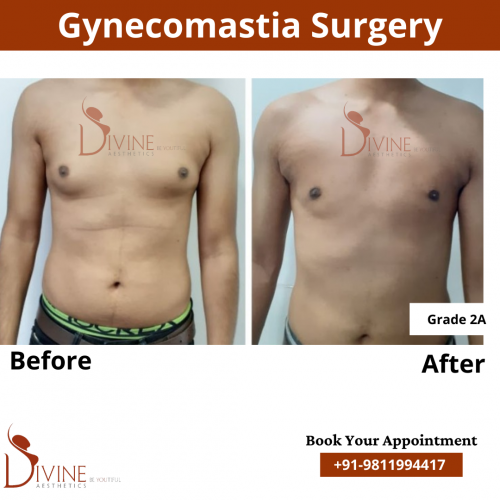gynecomastia before after pics