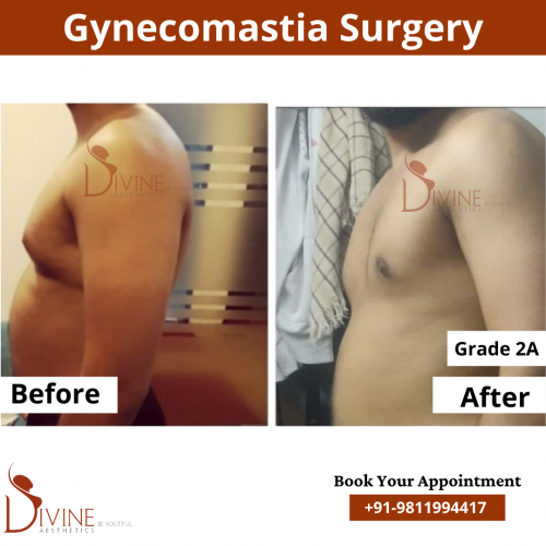 gynecomastia before after pics