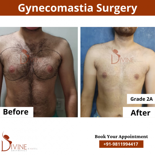 gynecomastia before after pics