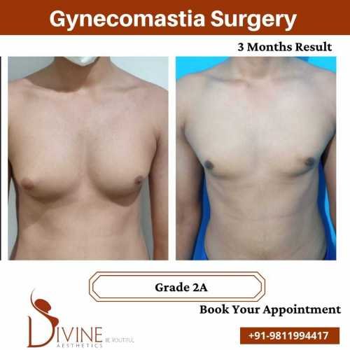 gynecomastia-grade-2-before-and-after-picture