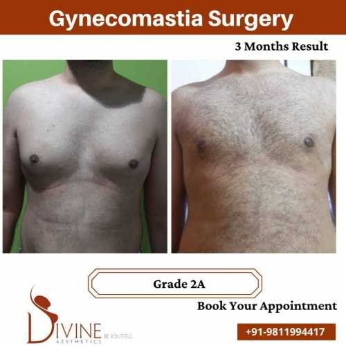 gynecomastia-grade-2-before-and-after-pictures