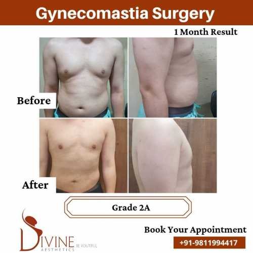 gynecomastia-grade-2-before-and-after-results