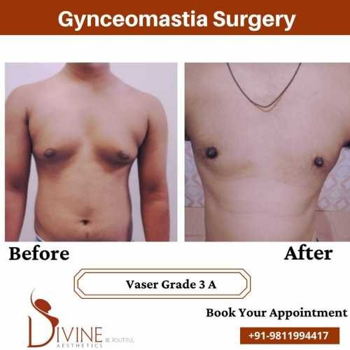 gynecomastia-in-delhi