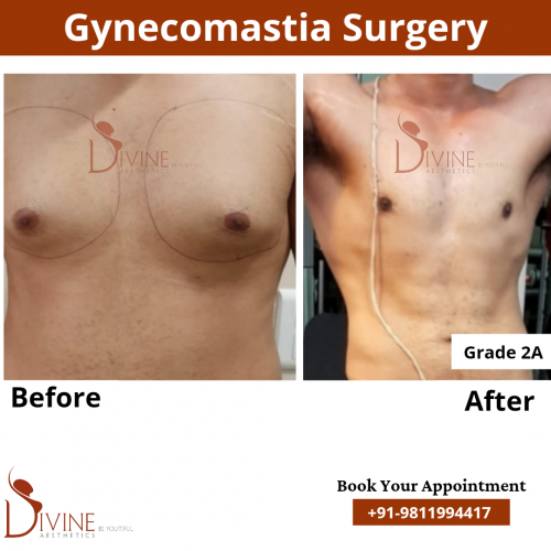 gynecomastia-in-delhi