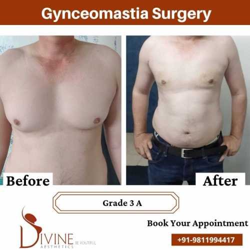 gynecomastia-surgeon-in-delhi