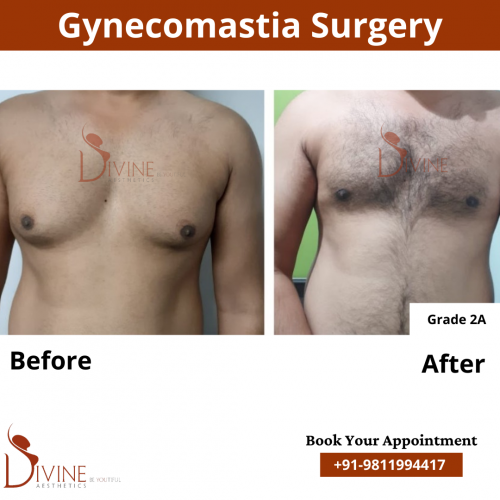 gynecomastia before after pics