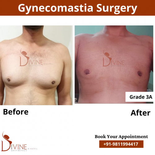 gynecomastia before after pics