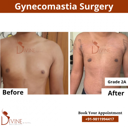 gynecomastia-surgery-in-delhi-cost