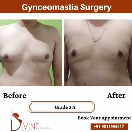 gynecomastia-surgery-in-delhi