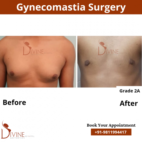 gynecomastia-surgery-in-delhi