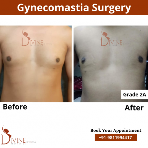 gynecomastia before after pics