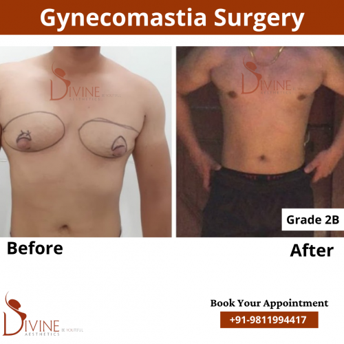 gynecomastia before after pics