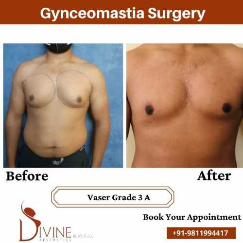 gynecomastia-treatment-cost-in-delhi
