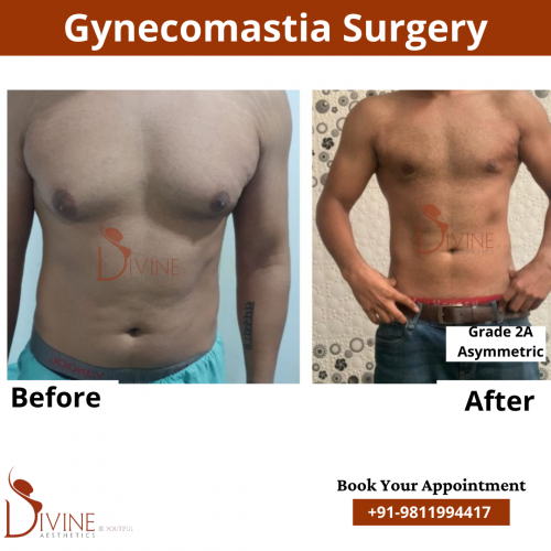 gynecomastia before after pics