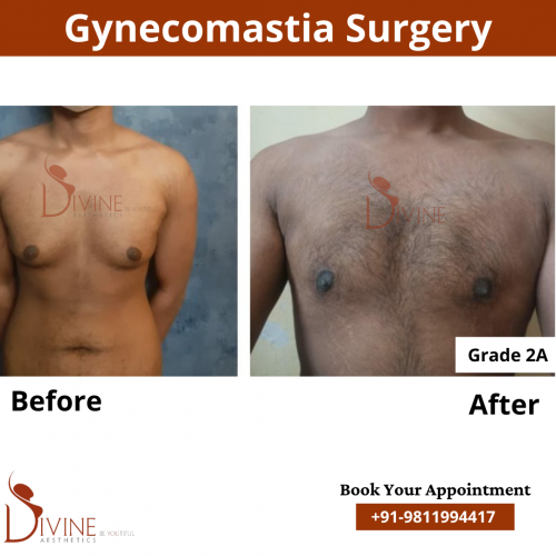 gynecomastia before after pics