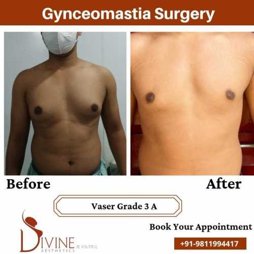 gyno-surgery-cost-in-delhi