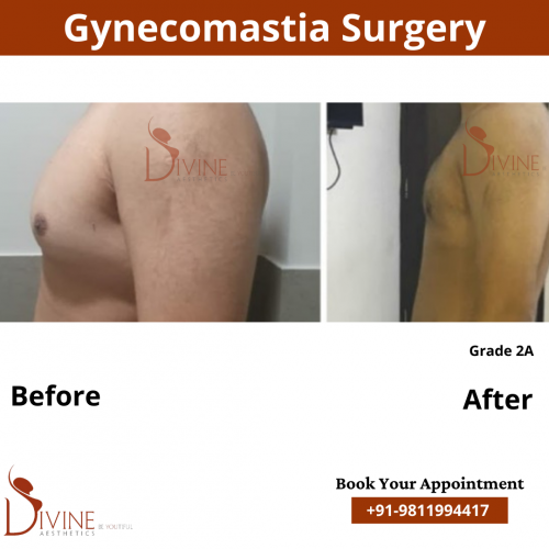 gynecomastia before after pics