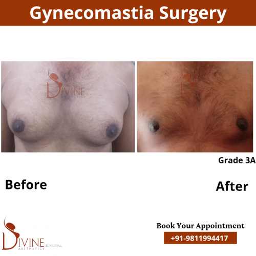 male-breast-reduction-in-delhi-1