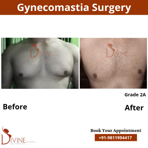 male-breast-reduction-in-delhi