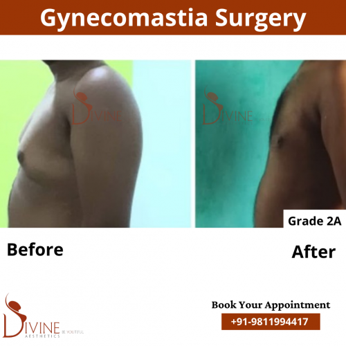 gynecomastia before after pics