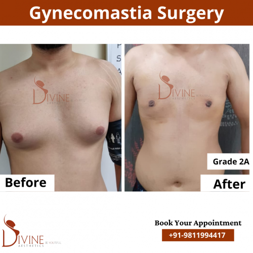 gynecomastia before after pics