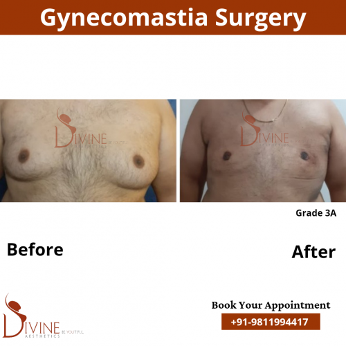 male-breast-reduction-surgery-in-delhi-1