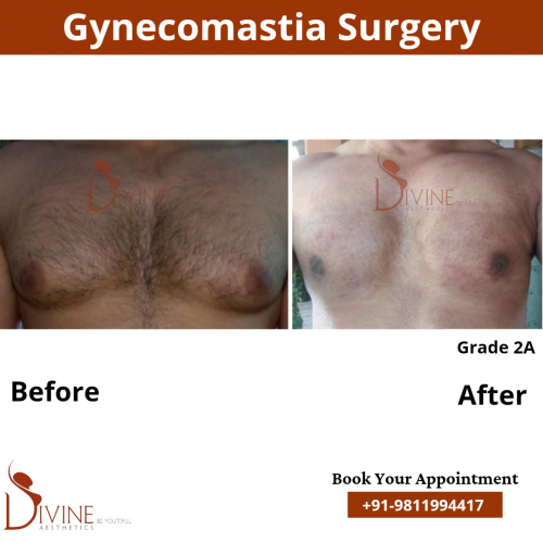 male-breast-reduction-surgery-in-delhi