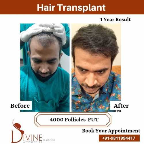 4000-follicles-Hair-Transplant-Before-After