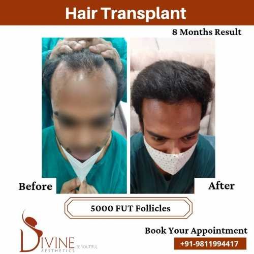 5000-follicles-Hair-Transplant-Before-After