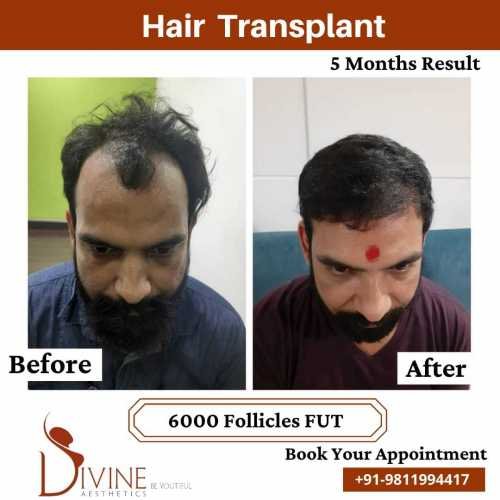 6000-follicles-FUT-Hair-Transplant-Before-After
