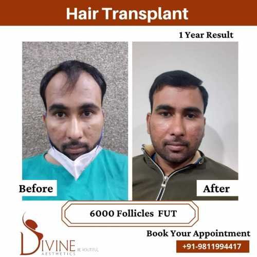 6000-follicles-Hair-Transplant-Before-After-1-Year-Result