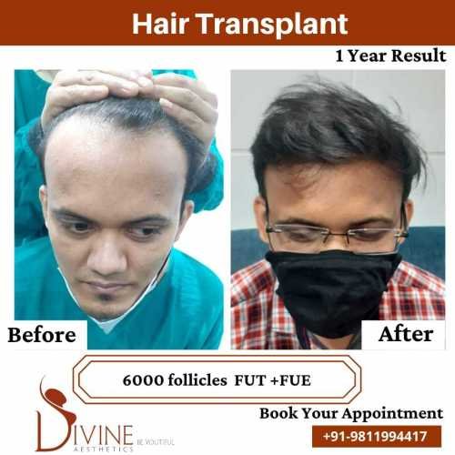 6000-follicles-Hair-Transplant-Before-After