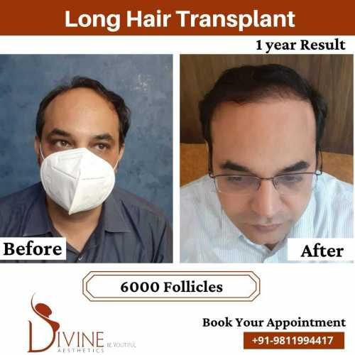 6000-follicles-Long-Hair-Transplant-Before-After